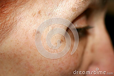 Pigmentation on the face. Brown spot on cheek. Pigment spot on the skin. Profile. Stock Photo