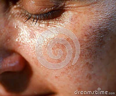 Pigmented spots on the face. Pigmentation on cheeks Stock Photo