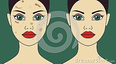 Piigment spots on female face Vector Illustration
