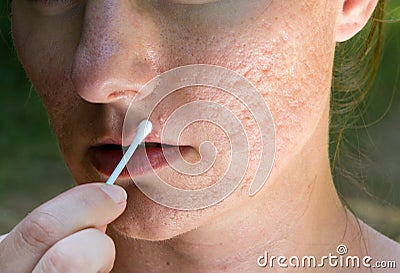 Pimple and acne scars Stock Photo