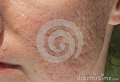 Pimple and acne scars Stock Photo