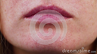 Angulus a Girl Inflammation the Corner of Her Lips. Stock Video - Video of medical, bacterium: 138346463