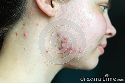 Pimples on the skin of a young girl close-up. Acne on the face of a teenage girl. Problems and treatment of acne in young people. Stock Photo