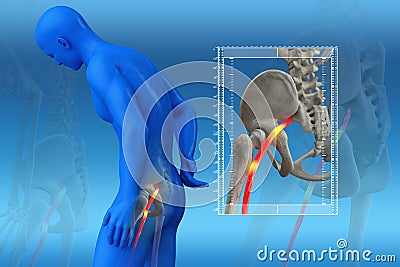 Pinched human sciatic nerve, anatomical vision. 3d illustration Cartoon Illustration