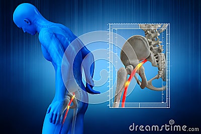 Pinched human sciatic nerve, anatomical vision. 3d illustration Cartoon Illustration