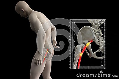 Pinched human sciatic nerve, anatomical vision. 3d illustration Cartoon Illustration