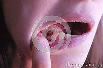 Pink tooth with caries and cured with using resorcinol-formalin paste. Stock Photo