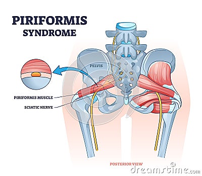 Piriformis syndrome and sciatic nerve compression pain outline diagram Vector Illustration