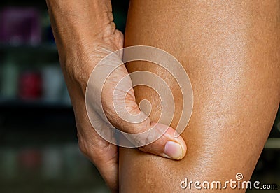 Pitting edema, clinical sign of heart disease patients or side effects of diclofenac oral drug, drug allergy. Stock Photo