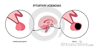 Pituitary adenoma cancer Vector Illustration