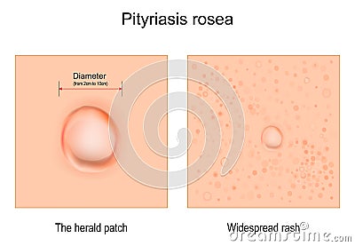 Pityriasis rosea. skin rash Vector Illustration