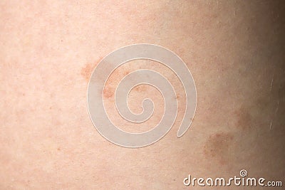 Pityriasis rosea three weeks after the appearance of the first focus on the skin of a young woman. A pink lichen is an approximati Stock Photo