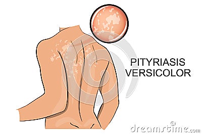 Pityriasis versicolor. dermatology. Vector Illustration