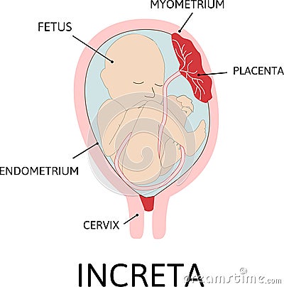 Placenta increta. grades of abnormal attachment illustrated according to the depth Cartoon Illustration