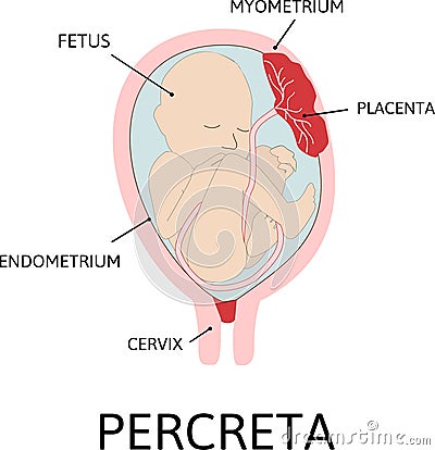 Placenta accreta. grades of abnormal attachment illustrated according to the depth Cartoon Illustration