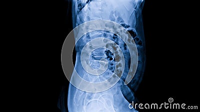 Compression fracture lumbar spine in osteoporosis or osteopenia patient. Stock Photo