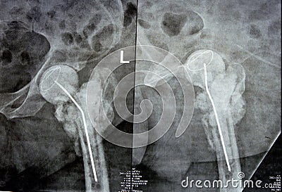 Plain X ray hip joint show left trans cervical fracture of the head of femur with temporary antibiotic loader spacer antibiotic- Stock Photo