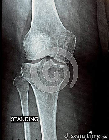 plain x ray on knee joint showing joint space narrowing and Subchondral Sclerosis on medial compartment Stock Photo