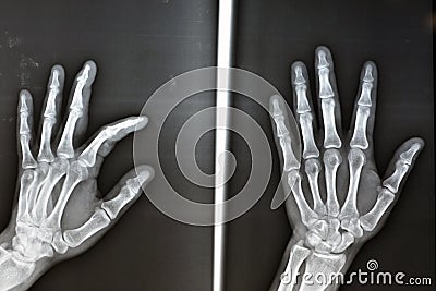 Plain x ray shows avulsion fracture base of the distal phalanx of the left middle finger, fracture of a small chunk of bone Stock Photo