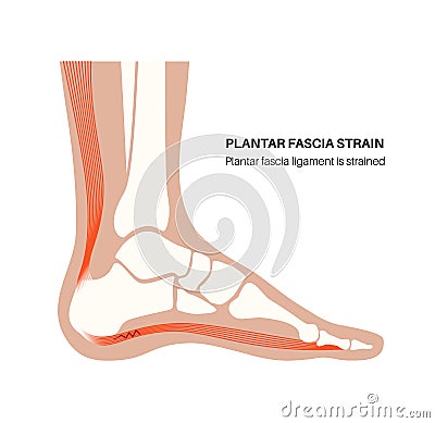 Plantar fascia strain Vector Illustration