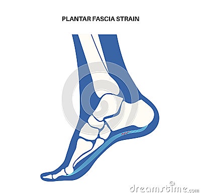 Plantar fascia strain Vector Illustration