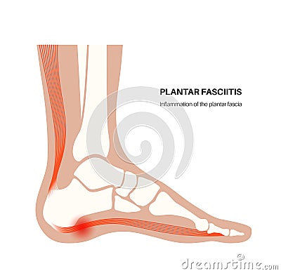 Plantar fasciitis concept Vector Illustration