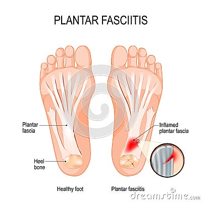 Plantar fasciitis. disorder of the connective tissue which supports the arch of the foot Vector Illustration