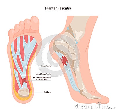 Plantar fasciitis. Plantar fascia inflammation or tearing. Disorder Vector Illustration