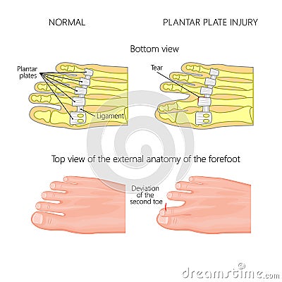 Plantar plate tear. Deviation of the toe Vector Illustration