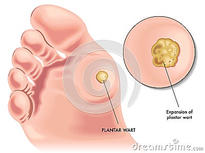 Plantar wart Vector Illustration