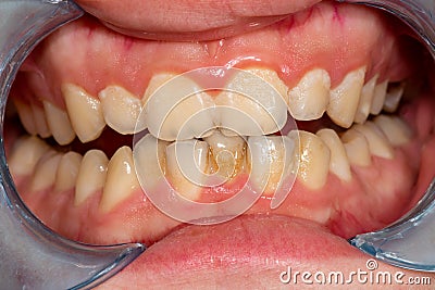 Plaque of the patient, stone. Dentistry treatment of dental plaque, professional oral hygiene. The concept of harm to smoking and Stock Photo