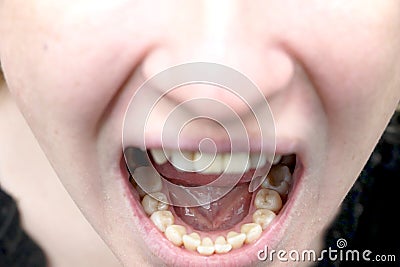 Plaque of the patient, stone. Dentistry treatment of dental plaque, professional oral hygiene, The concept of harm to smoking and Stock Photo