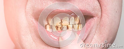 Plaque teeth cavities and paradontosis in the man`s mouth. Dental decay problems and bad smile. Dentist treatment, health care Stock Photo