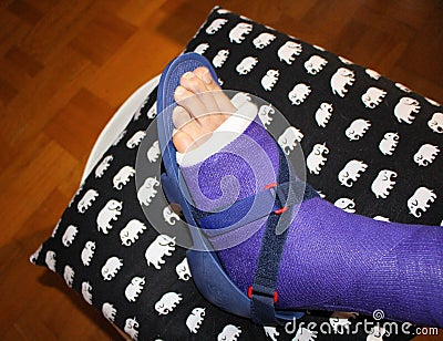 A broken ankle with purple plaster Editorial Stock Photo