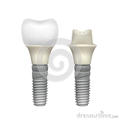 Plastic assembled tooth implant Vector Illustration