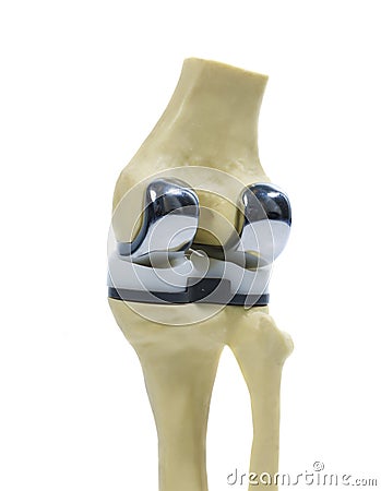 Plastic model of a knee replacement Stock Photo