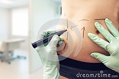Plastic surgeon marking womans body for surgery Stock Photo
