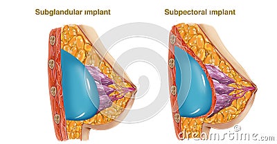 Plastic surgery Cartoon Illustration