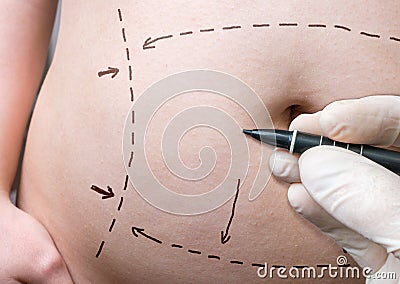 Plastic surgery concept. Hand is drawing lines with marker on belly Stock Photo