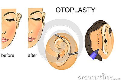 Plastic surgery. correction of protruding ears Stock Photo