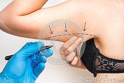 Plastic surgery doctor draw line on patient arm Stock Photo