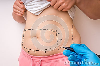 Plastic surgery doctor draw lines with marker on patient belly Stock Photo