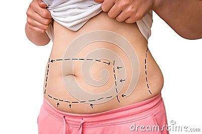 Plastic surgery doctor draw lines with marker on patient belly Stock Photo