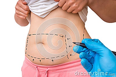 Plastic surgery doctor draw lines with marker on patient belly Stock Photo