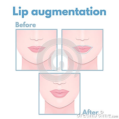 Plastic surgery lip Vector Illustration