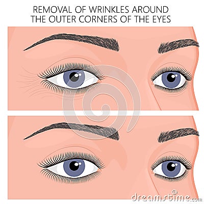 Plastic surgery_Removal of wrinkles around the outer corners of Vector Illustration
