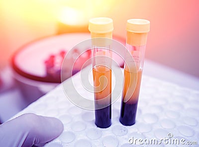 Platelet-Rich plasma preparation. Tube with blood in hands. Stock Photo