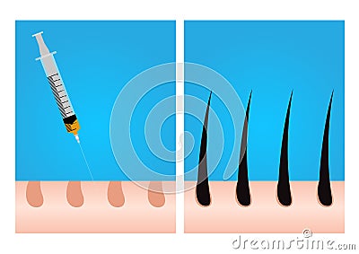 Platelet-Rich plasma . prp . hair growth vector Vector Illustration