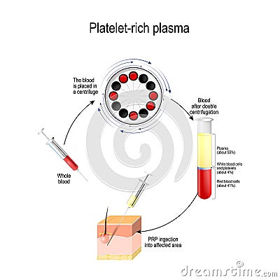 Platelet-rich plasma. PRP is a Medical procedure for Hair growth stimulation Vector Illustration