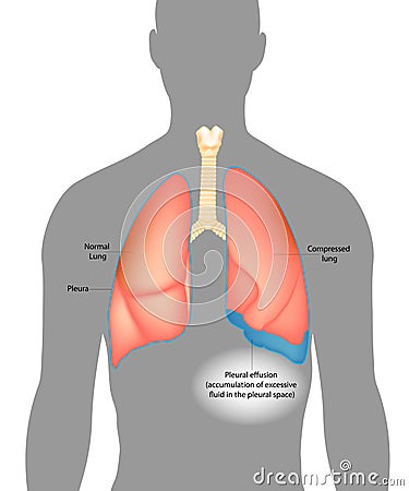 Pleural effusion.Accumulation of excessive fluid in the pleural space. Vector Illustration